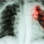 Tuberculose